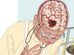 Кровоизлияние в мозг.